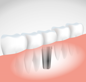implantáty